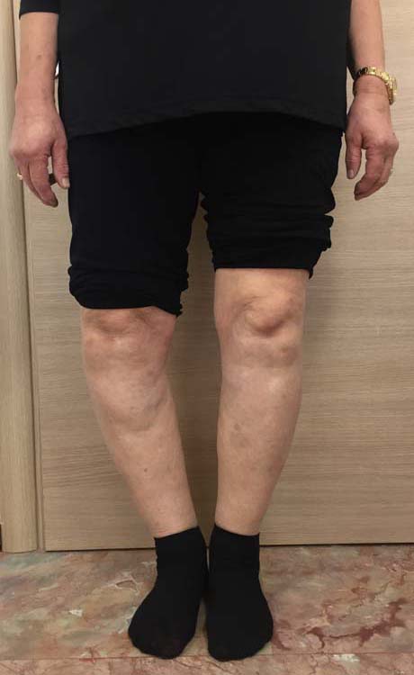 Παραμόρφωση ραιβότητας του γόνατος δεξιά και επιδείνωση του προβλήματος κατά τη διάρκεια της βάδισης