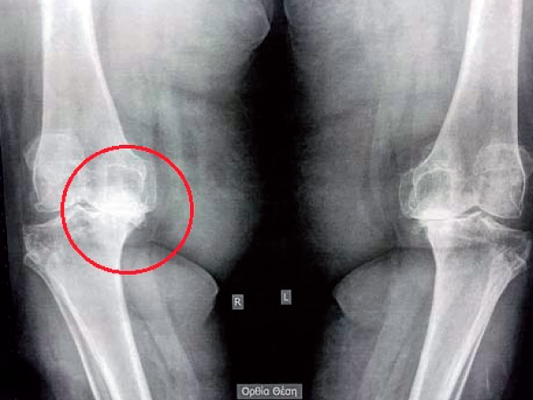 Pre-op X-ray, severe osteoartrhitis of the knees bilaterally (final stage - bone to bone contact)