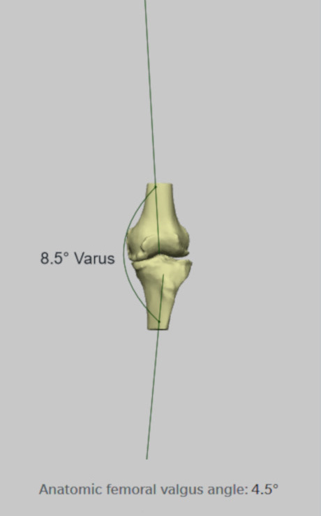 Varus deformity 8.5 degree of the left knee (Mechanical knee axis)
