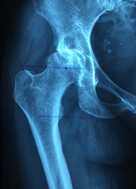 Ακτινολογική εικόνα:  Βαριά αρθρίτιδα στο δεξί ισχίο λόγω συγγενούς δυσπλασίας της κοτύλης