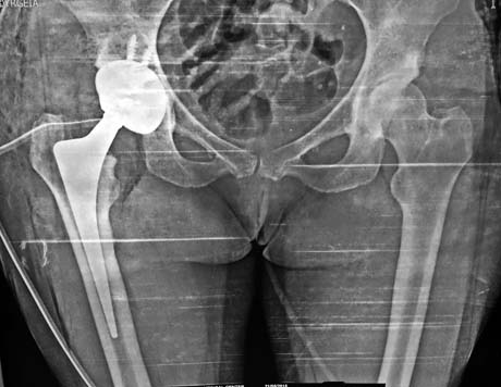 Post op X-ray,  ALMIS right hip arthroplasty