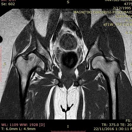 Μαγνητική τομογραφία των ισχίων πριν το χειρουργείο.  Ανάδειξη της παραμόρφωσης της κεφαλής του μηραίου λόγω της νόσου LEG PERTHES CALVE οστεονέκρωσης της μηριαίας κεφαλής